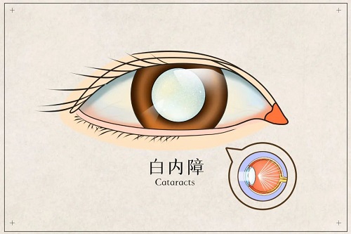 【健康科普】視線模糊不清,？當(dāng)心患上白內(nèi)障